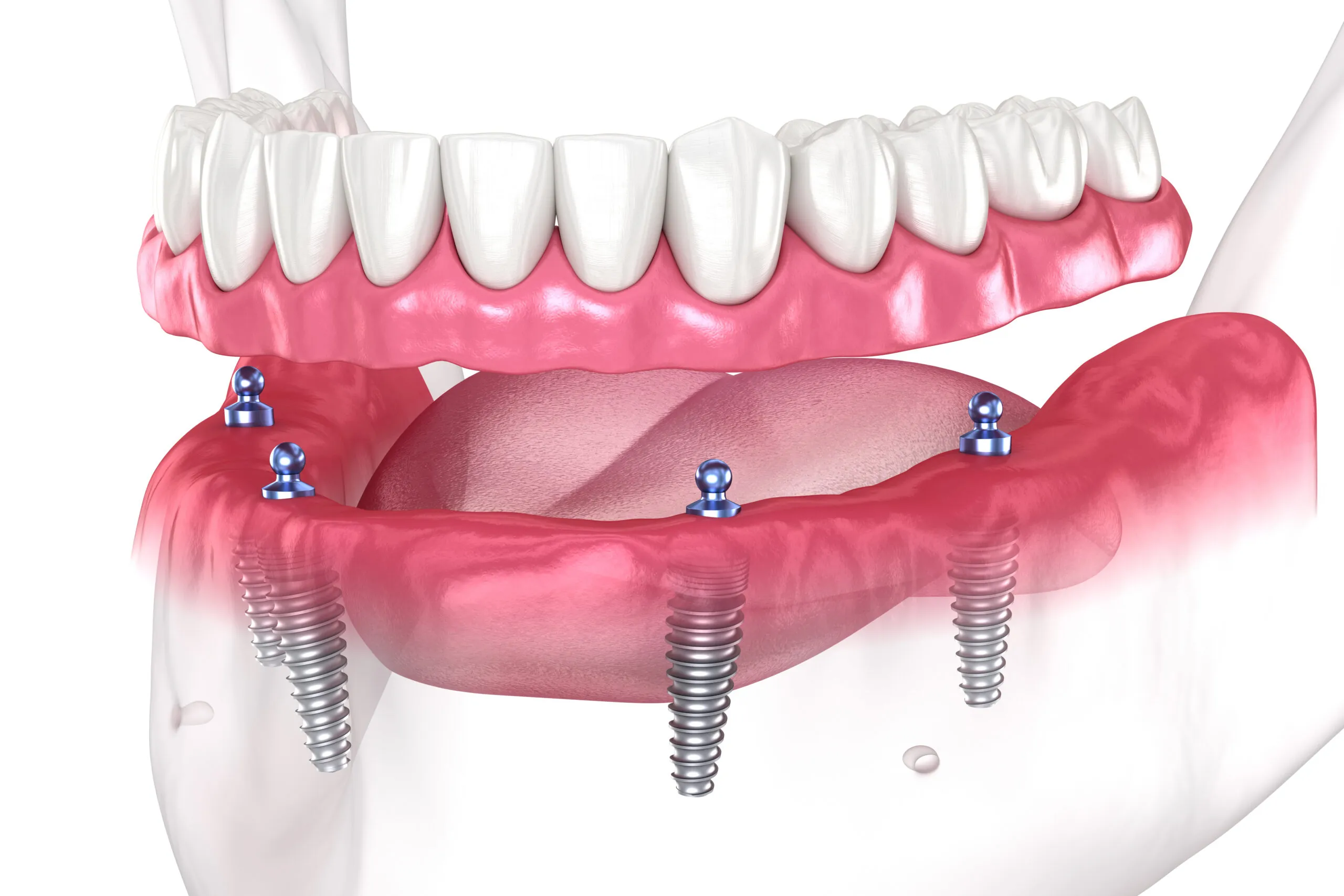Dental Implants for Missing Teeth: Everything You Need to Know